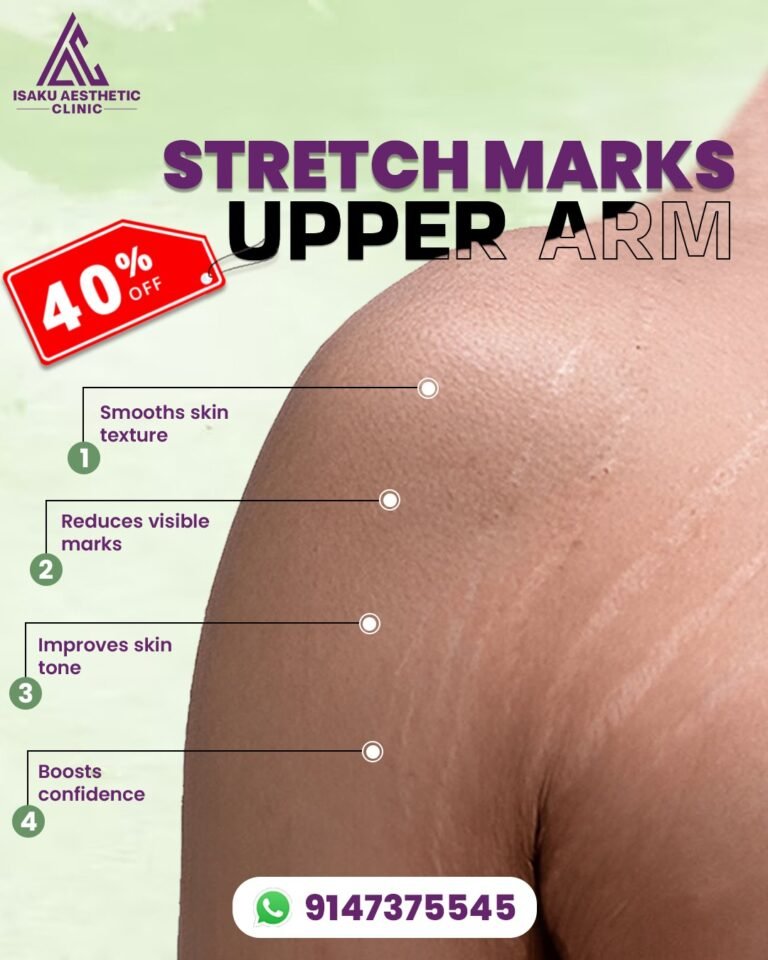 Stretch marks Upper Arm - Isaku Aesthetic Clinic Kolkata